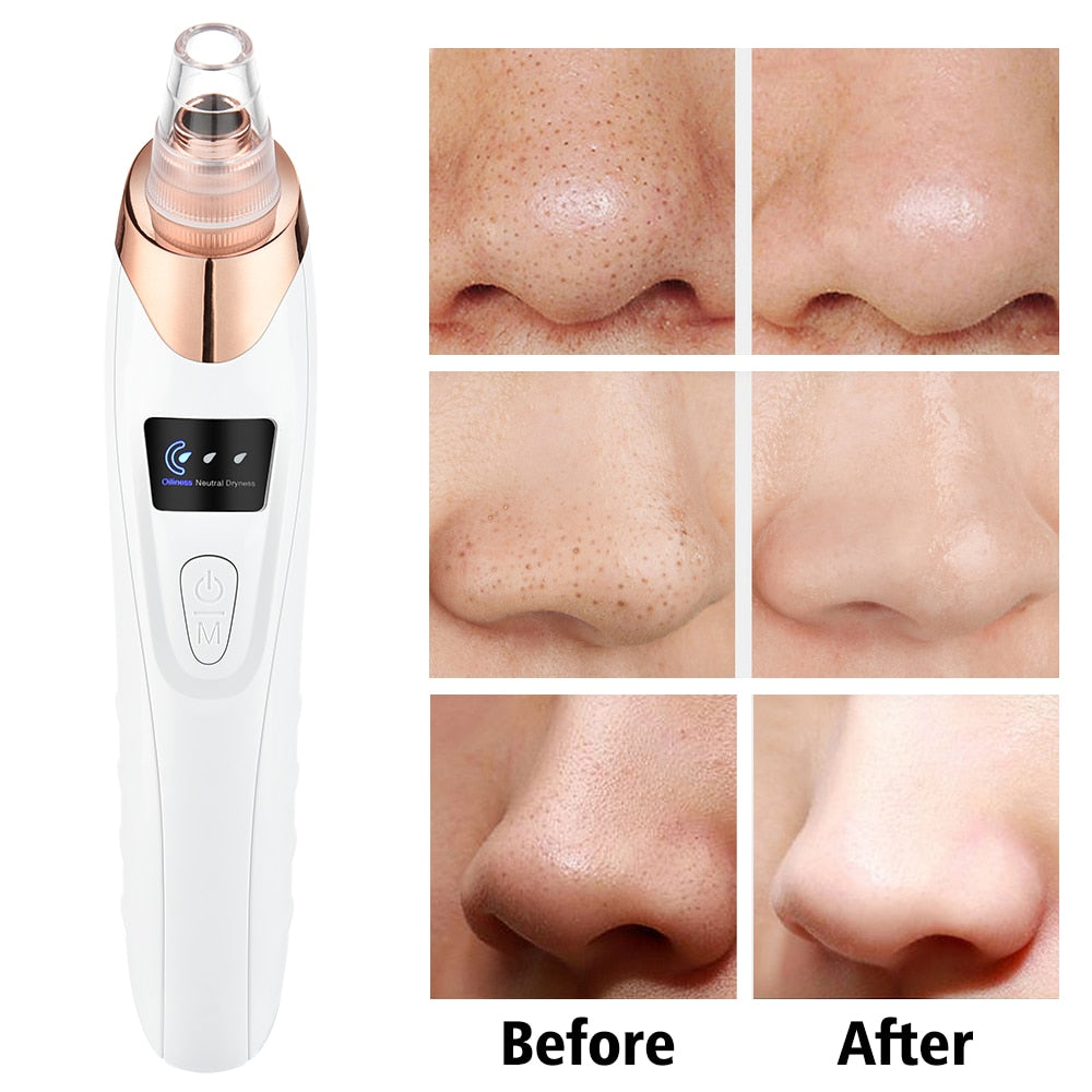 Blackhead Remover Vacuum Pore Cleaner Facial Cleaning Black Dots Suction Exfoliating Beauty Acne Pimple Remover Tool Skin Care - acfitpro