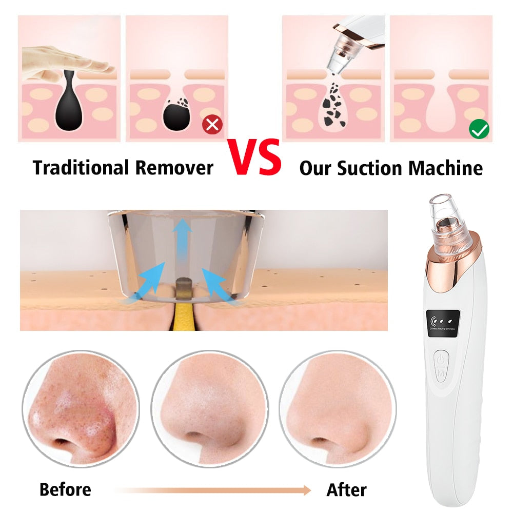 Blackhead Remover Vacuum Pore Cleaner Facial Cleaning Black Dots Suction Exfoliating Beauty Acne Pimple Remover Tool Skin Care - acfitpro